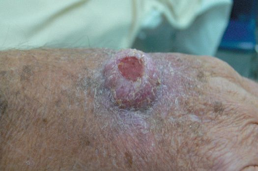 Squamous cell carcinoma of the face, and recurrent SCC arising in a previously treated site