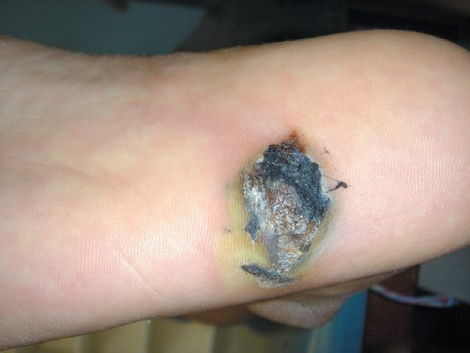 Acral lentiginous melanoma on the sole of the foot, and subungual melanoma
