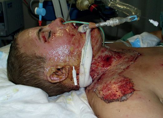 Burns to the face and neck with inhalation injury requiring intubation