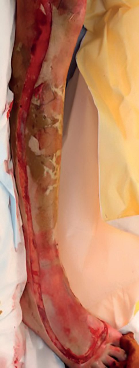 Extensive full-thickness burn of the lower limb at first operation, showing the placement of the escharotomy incisions