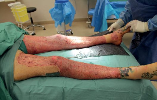 Full-thickness leg burns after excision to healthy tissue, with meshed split-skin graft seen at the first dressing change