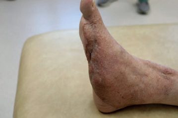 One year after high-voltage electrical injury requiring amputation of the lateral three toes, treated with a dermal substitute and skin grafting