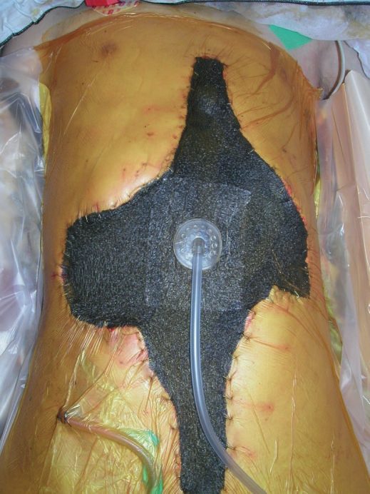 Negative-pressure wound therapy in an open abdomen: a non-adherent dressing overlaid by a sponge, sealed with an airtight membrane and connected to suction