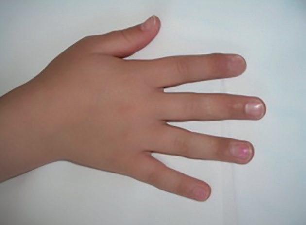 Full-thickness skin graft reconstruction of a contact burn to the dorsum of the digits
