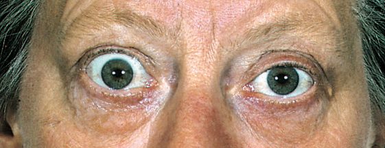 Exophthalmos in dysthyroid eye disease