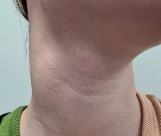 Right branchial cyst, anterior and oblique views