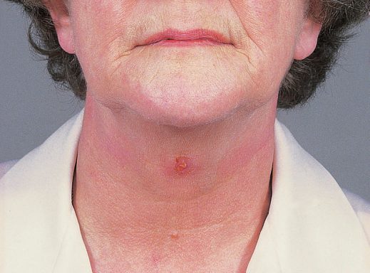 Thyroglossal fistula arising from a cyst in the midline of the neck