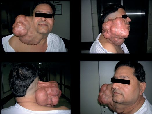 Large pleomorphic adenoma grown over 15 years