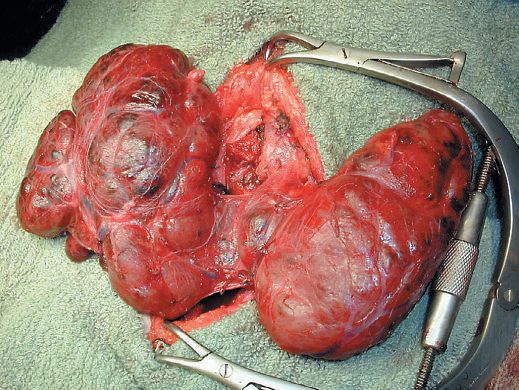 Total thyroidectomy specimen for dyshormonogenetic goitre in a 14-year-old girl