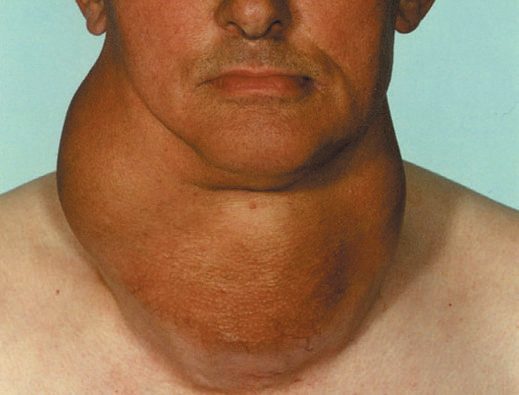 Large multinodular goitre
