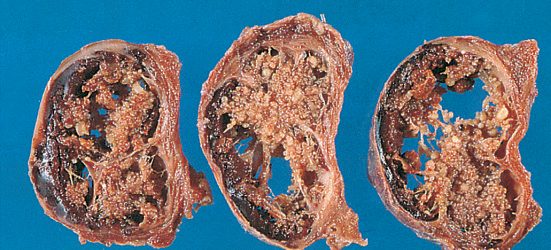 Cyst formation in a papillary carcinoma, seen on sliced gross specimen