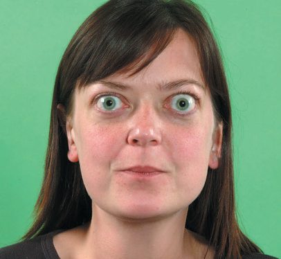 Graves' disease with diffuse goitre and bilateral exophthalmos