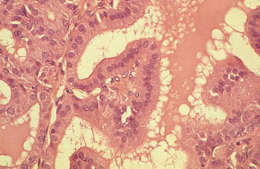 Histology of thyrotoxicosis, showing hyperplastic follicular epithelium with scalloped colloid
