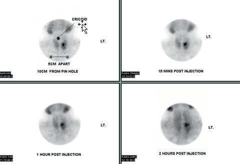 Sestamibi scan sequence demonstrating a right inferior parathyroid adenoma with persistent tracer retention on delayed images