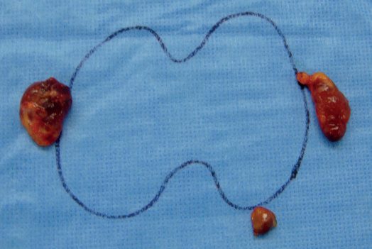 Subtotal parathyroidectomy for parathyroid hyperplasia: excised glands with the right inferior gland biopsied and half left in situ