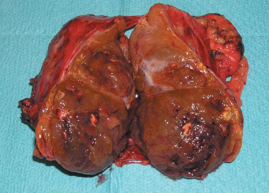 Adrenocortical carcinoma that caused Cushing's syndrome and virilisation in a female patient