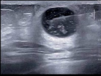 Therapeutic aspiration of a complicated breast cyst: ultrasonography shows the needle within a sharply defined cyst containing internal echoes