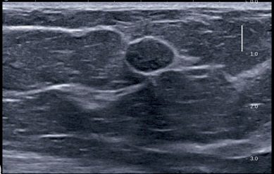 Fibroadenoma on ultrasonography: a well-circumscribed solid mass in a young woman, BI-RADS score 3