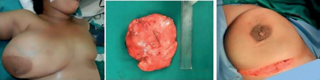 Giant fibroadenoma. (a) Clinical appearance; (b) excised specimen; (c) the submammary (Gaillard Thomas) incision used for excision