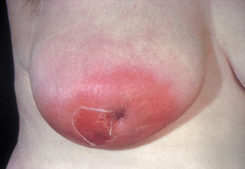 Lactational breast abscess: a tender fluctuant swelling with overlying erythema and a pointing, ulcerated discharge site