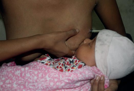 Breastfeeding continued while a drainage catheter for a lactational breast abscess is in place