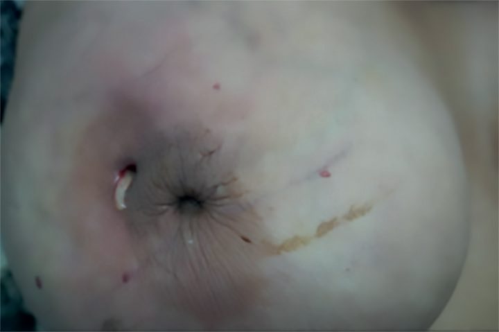 Periductal mastitis: a retracted nipple with a mammary duct fistula discharging pus at the edge of the areola