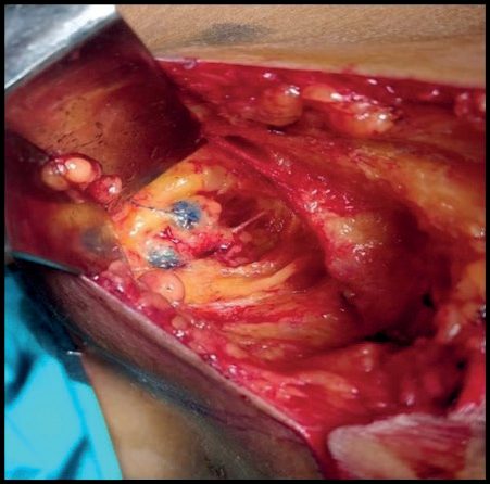 Sentinel lymph node biopsy using methylene blue dye: blue-stained sentinel nodes and lymphatics identified in the axilla