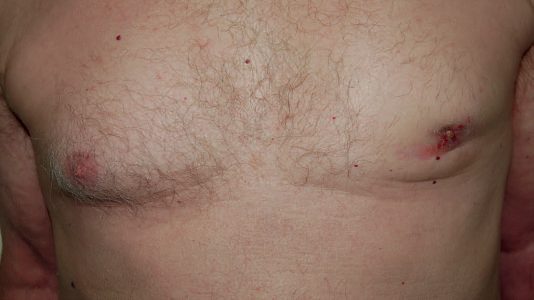Carcinoma of the male left breast: the eccentric, non-tender, skin-involving mass that must be distinguished from gynaecomastia