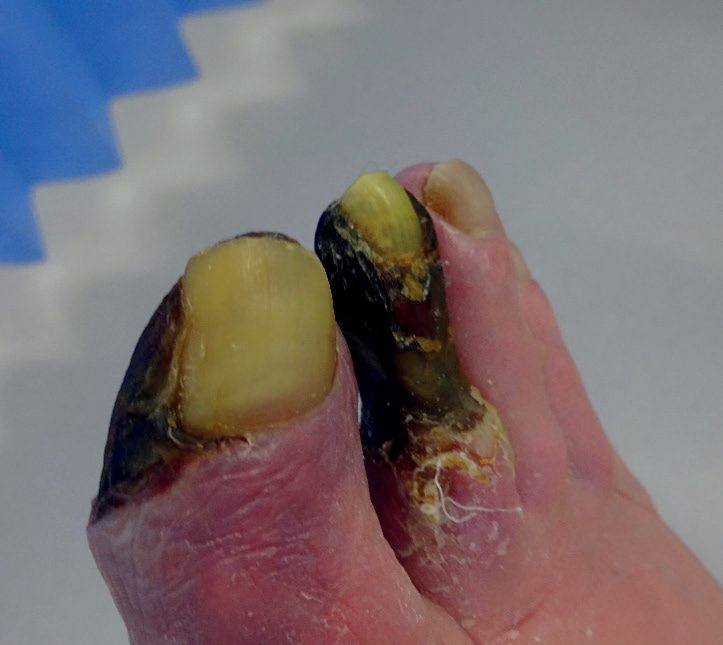 Chronic limb-threatening ischaemia with dry gangrene of the toes
