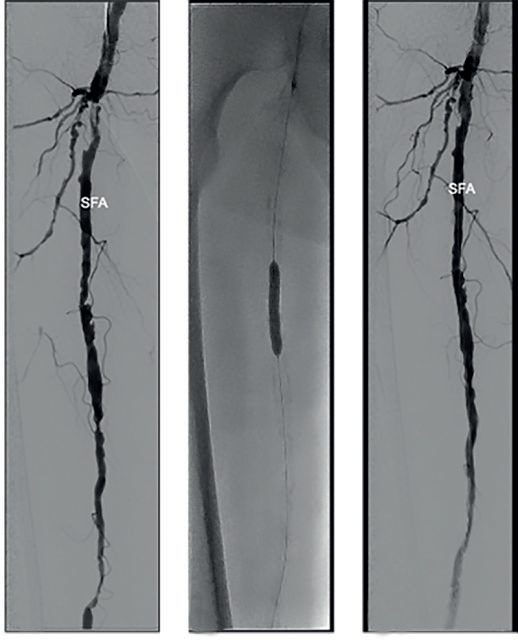 Digital subtraction angiogram showing multiple superficial femoral artery stenoses (left), balloon angioplasty of the SFA (centre) and the post-angioplasty result (right)