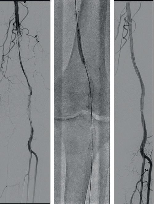 Endovascular treatment of an occluded popliteal artery: the occlusion, the lesion crossed with a catheter, and the completion angiogram after stenting