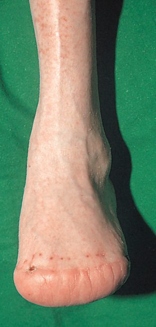 Healed transmetatarsal amputation performed for diabetic gangrene of the toes