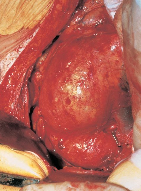 Operative appearance of a large, non-ruptured infrarenal abdominal aortic aneurysm exposed at open repair