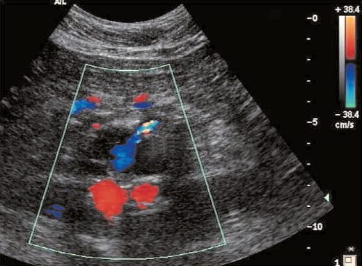 Duplex ultrasound after EVAR showing the aortic sac in cross-section with the two endograft limbs and a type II endoleak from the inferior mesenteric artery