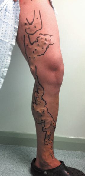 Left leg varicose veins in the distribution of an incompetent great saphenous vein, marked preoperatively for intervention