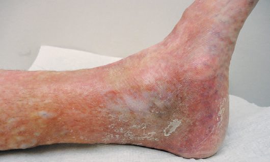 Advanced skin changes of chronic venous insufficiency in the gaiter area: lipodermatosclerosis, eczema and atrophie blanche