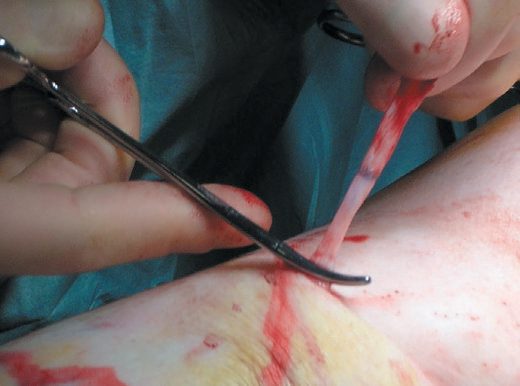 Phlebectomy performed under tumescent anaesthesia following endothermal ablation, with the varix avulsed through a stab incision using a hook