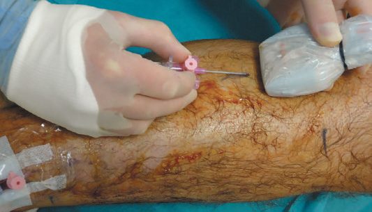 Phlebectomy performed under tumescent anaesthesia, and cannulation for foam sclerotherapy