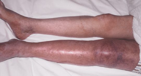 Phlegmasia cerulea dolens: the left leg is grossly swollen and dusky-blue from massive iliofemoral venous thrombosis