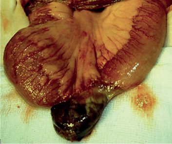 A gangrenous Richter's hernia from a case of strangulated femoral hernia