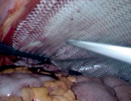 Polypropylene mesh positioned in a totally extraperitoneal (TEP) laparoscopic inguinal hernia repair; the blue orientation lines help the surgeon site the mesh