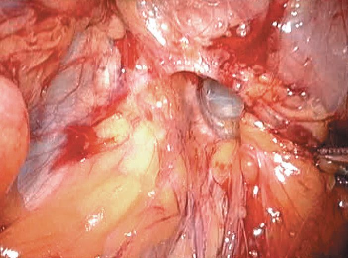 Right femoral hernia seen at laparoscopy, the defect lying below the obliquely running inguinal ligament