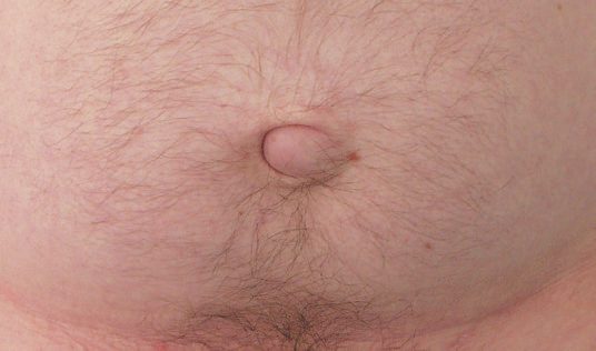 A small adult umbilical hernia