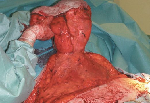 A massive umbilical hernia, intraoperative view