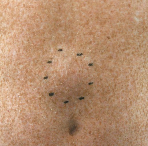 Epigastric hernia, with the defect marked on the skin in the upper midline