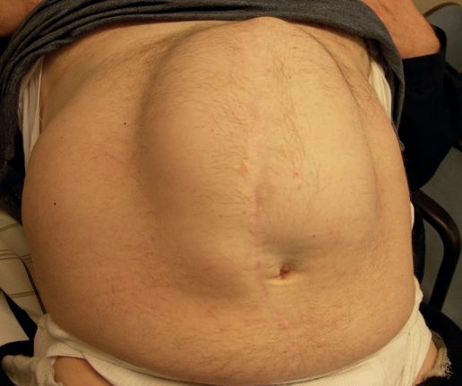 A large incisional hernia involving the full length of the previous incision