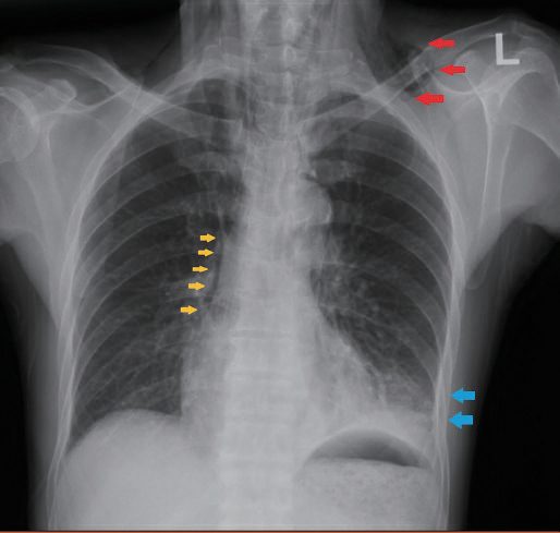 Chest radiography showing pleural effusion (blue arrows), subcutaneous emphysema (red arrows) and pneumomediastinum (yellow arrows)