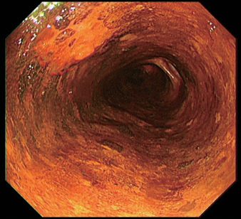 Endoscopic pictures of the oesophagus, including high-grade dysplasia stained by chromoendoscopy