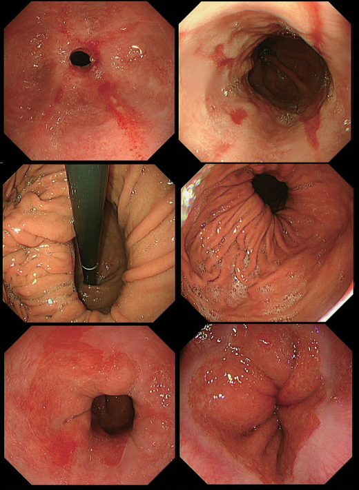 Endoscopic appearances: oesophageal stricture with oesophagitis (a); Los Angeles grade C oesophagitis (b); hiatus hernia (c, d); Barrett's oesophagus (e); normal OGJ (f)
