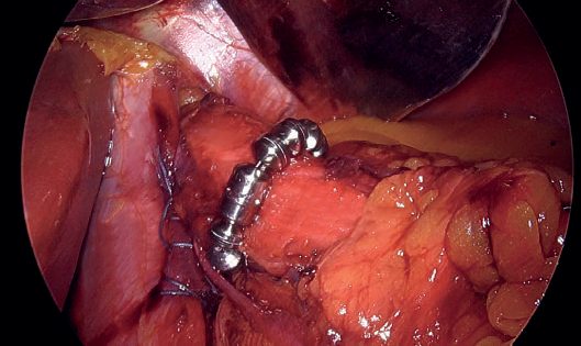 Magnetic sphincter augmentation: intraoperative photograph after hiatus hernia repair, with the magnetic device implanted around the lower oesophagus